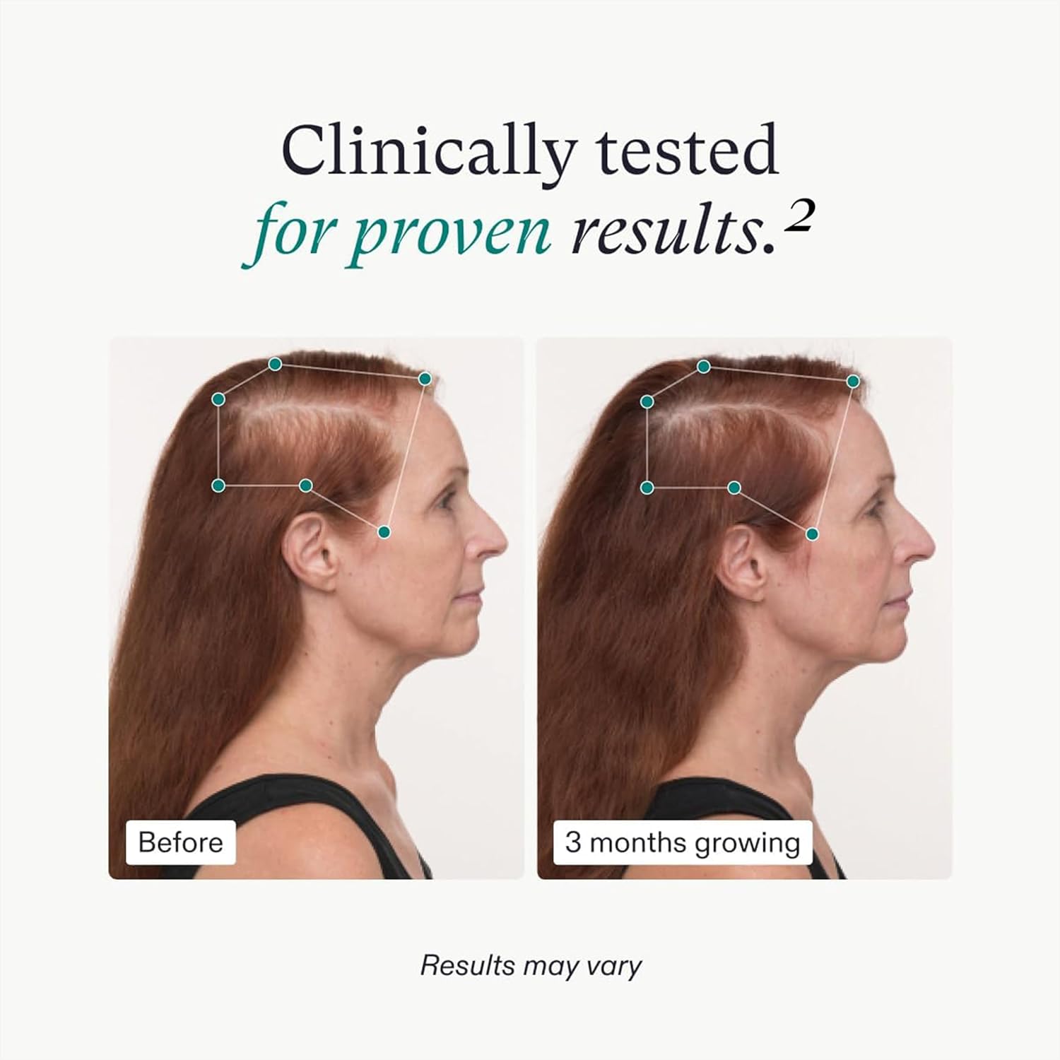 Women's Balance Hair Growth Supplements for Ages 45 and Above, Clinically Proven for Enhanced Hair Thickness and Scalp Coverage, Dairy-Free and Soy-Free, Dermatologist Recommended - One Month Supply